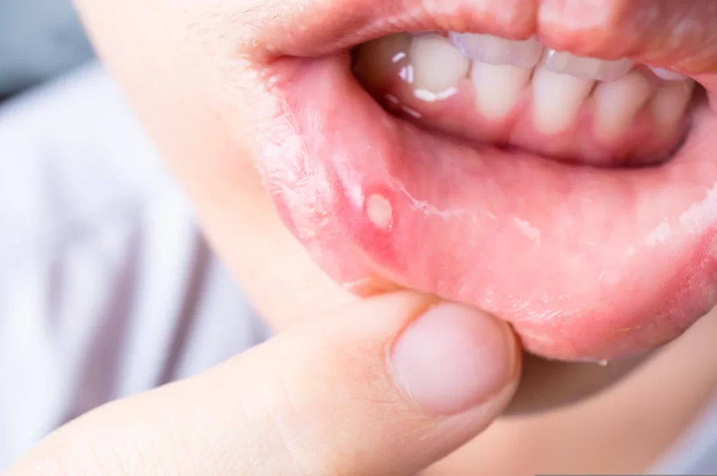 L'aftosi orale, conosciuta anche come stomatite aftosa ricorrente o ulcere aftose, è una condizione che provoca la comparsa di ulcere dolorose all'interno della bocca.