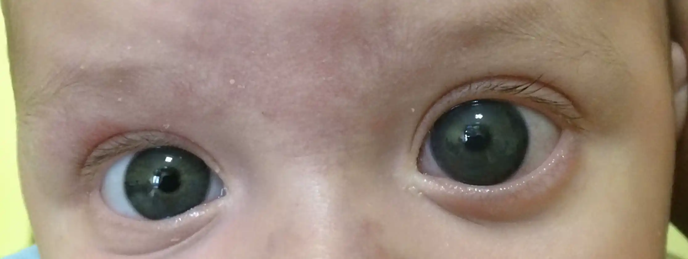 Buftalmo - problema alla cornea e all'occhio