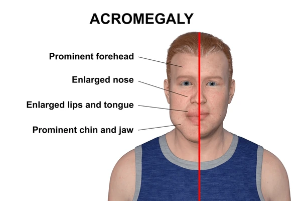 Acromegalia sintomi e diagnosi