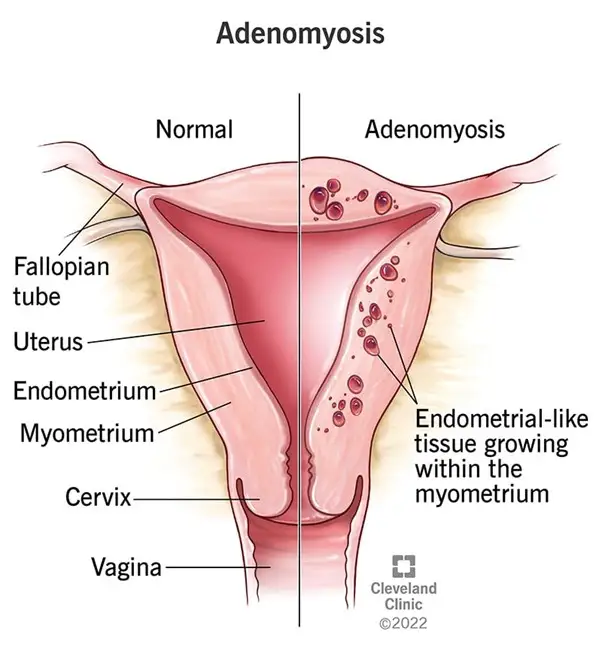 Utero adenomiosi