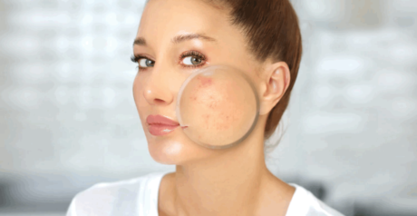 Combattere l’acne con una dieta mirata: evitare latticini, cibi ad alto indice glicemico e grassi saturi, privilegiando alimenti ricchi di omega-3, vitamine e fibre. Consigli basati su studi scientifici per una pelle più sana