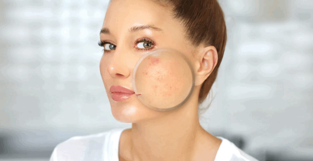 Alimentazione e Acne