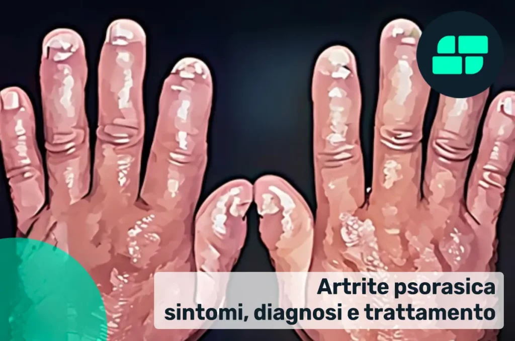 Artrite psoriasica