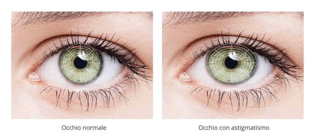 Occhio con/senza astigmatismo 