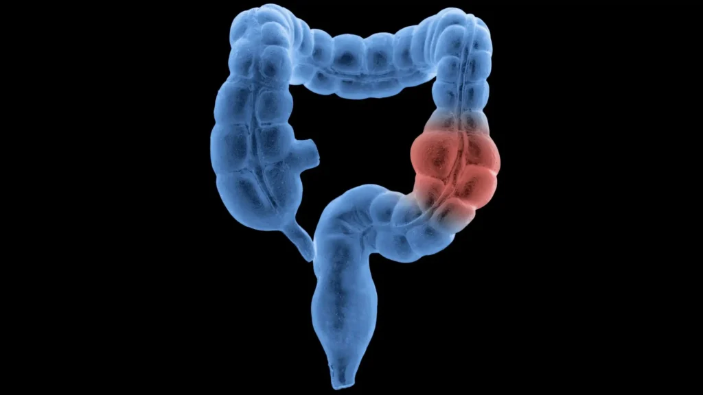 Ridurre il consumo di cibi ultraprocessati come prevenzione per cancro al colon