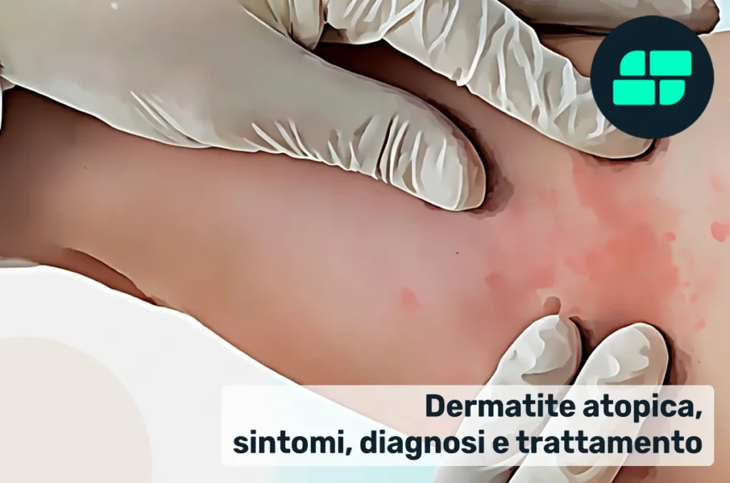 La dermatite atopica è la malattia infiammatoria cutanea più diffusa