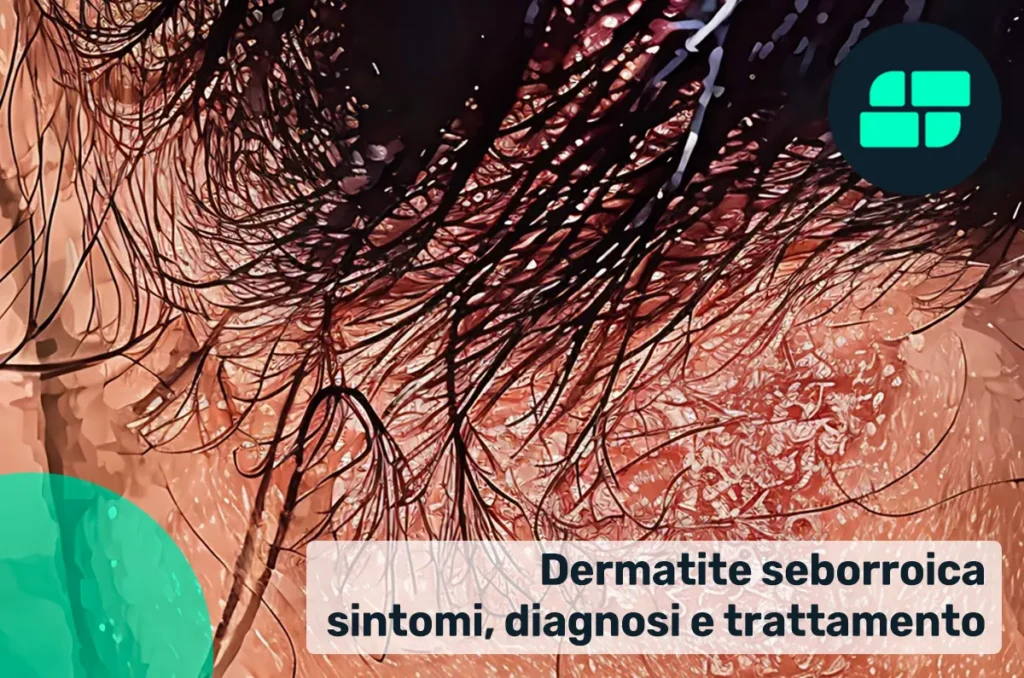 Dermatite seborroica