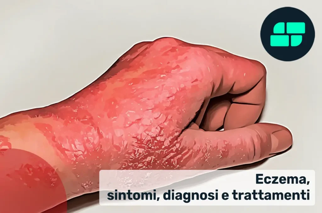 Sintomi eczema