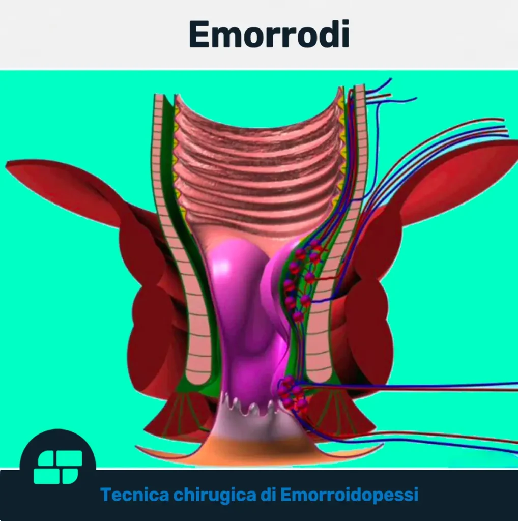 L'emorroidopessi è conosciuta anche come procedura di Longo o emorroidectomia con suturatrice meccanica circolare