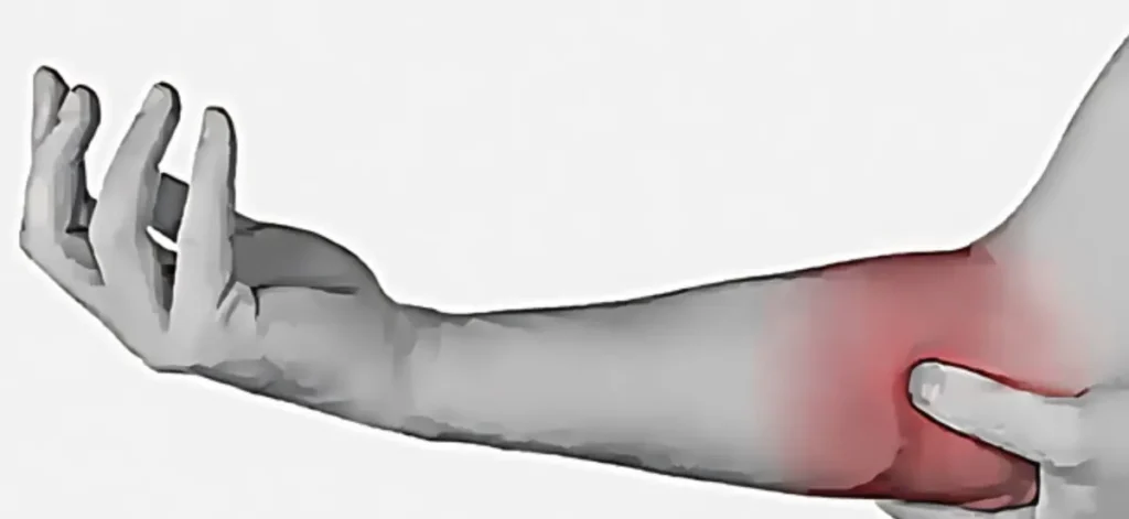 I migliori rimedi naturali, consigli alimentari e dispositivi ortopedici per trattare efficacemente il gomito del golfista. Alleviare dolore e infiammazione, favorendo una pronta guarigione e prevenzione