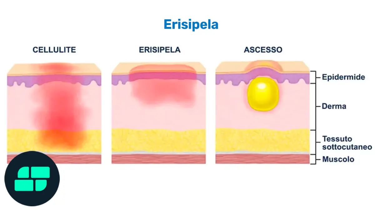 Differenze tra erisipela ed altre patologie cutanee