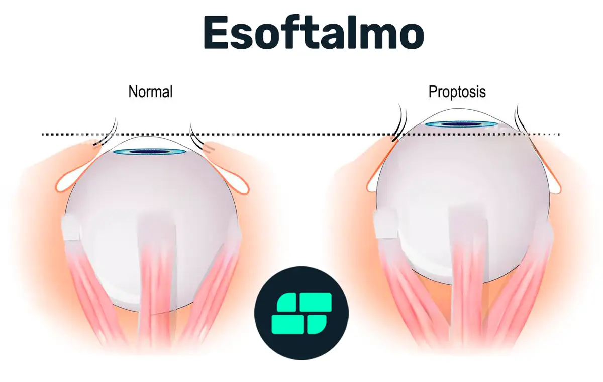 Esoftalmo Cause, Sintomi, Diagnosi e Cura per gli Occhi Sporgenti