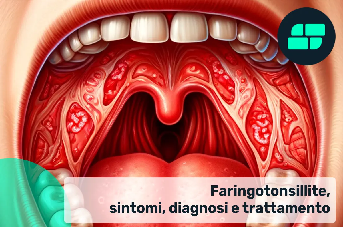 Sintomi e diagnosi della faringotonsillite