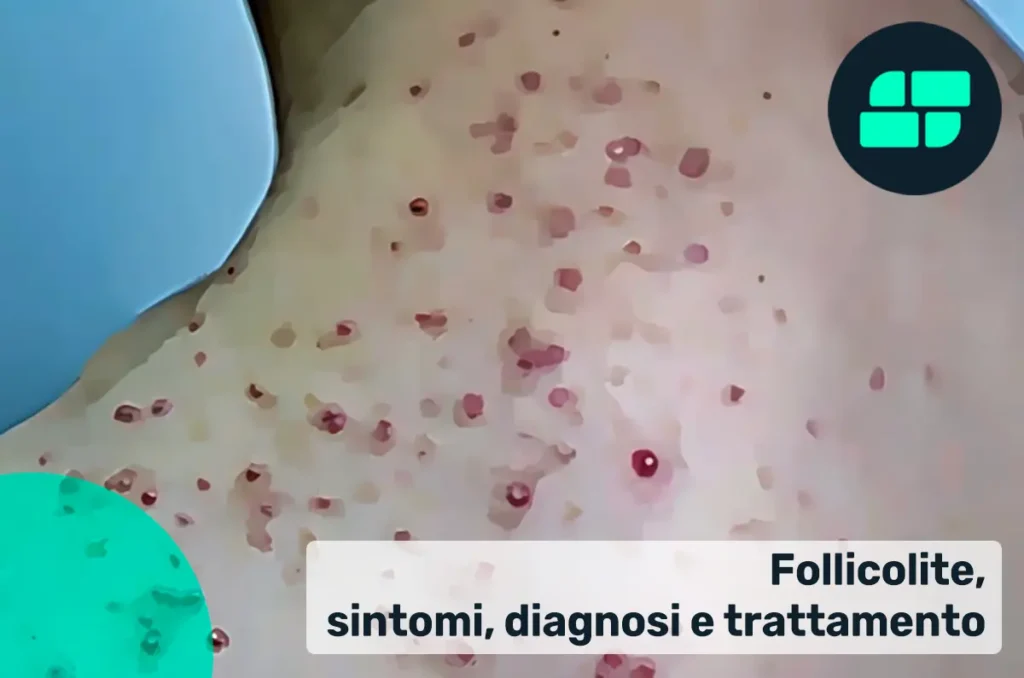 Sintomi follicolite