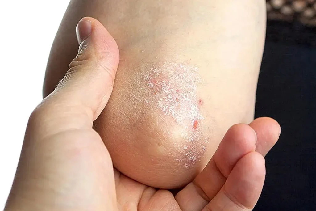 La psoriasi