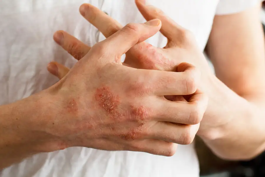 La psoriasi rappresenta una condizione complessa in cui sistema immunitario, genetica e ambiente interagiscono in modo dinamico
