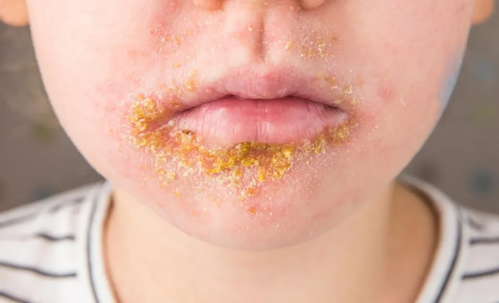 Impetigine nei bambini