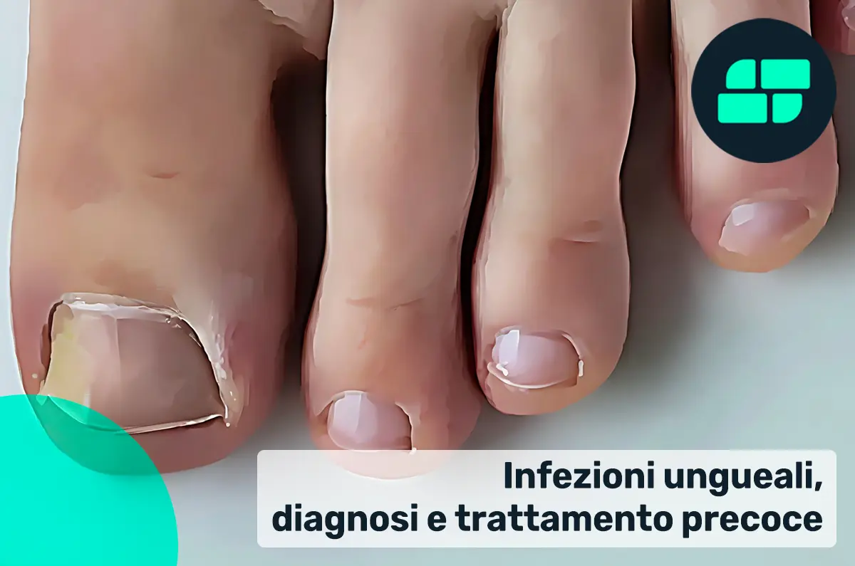 Sintomi infezioni ungueali