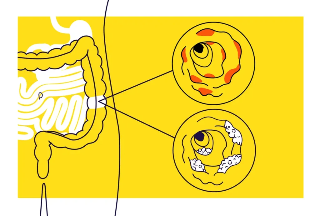 Le malattie infiammatorie croniche intestinali non sono più una condanna, ma una sfida che può essere vinta grazie a conoscenza, innovazione e collaborazione