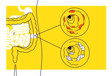 Le malattie infiammatorie croniche intestinali non sono più una condanna, ma una sfida che può essere vinta grazie a conoscenza, innovazione e collaborazione