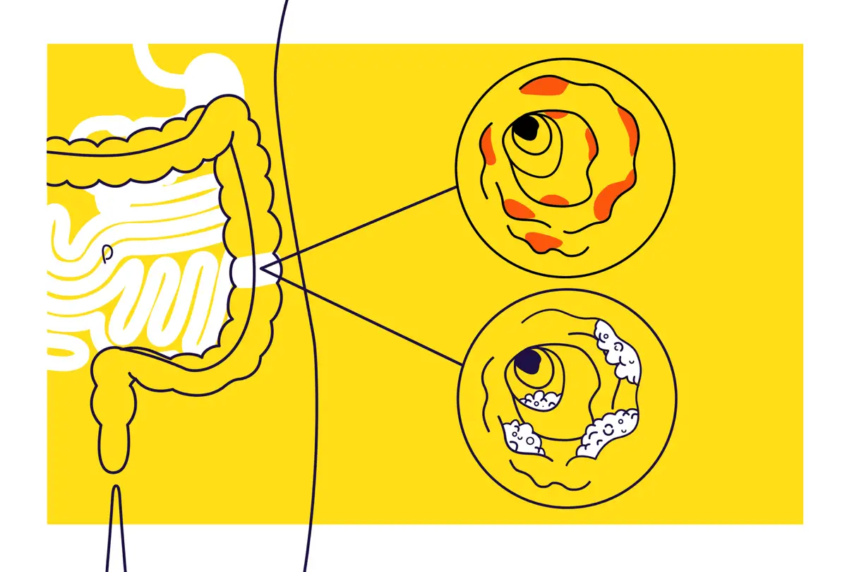 Le malattie infiammatorie croniche intestinali, incidenza e forme principali