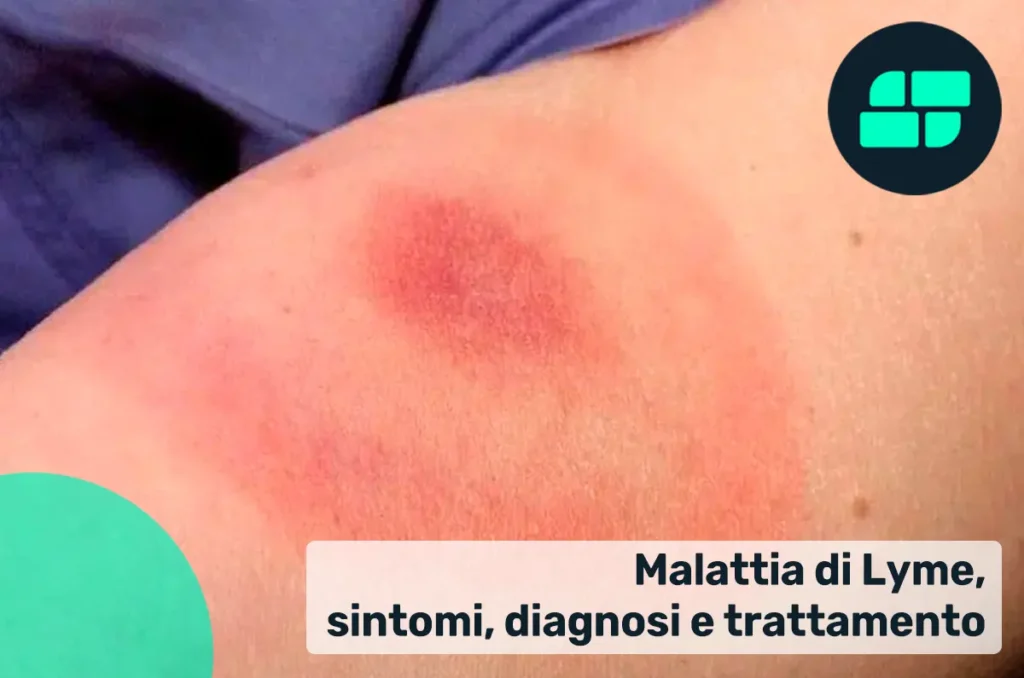 Malattia di Lyme