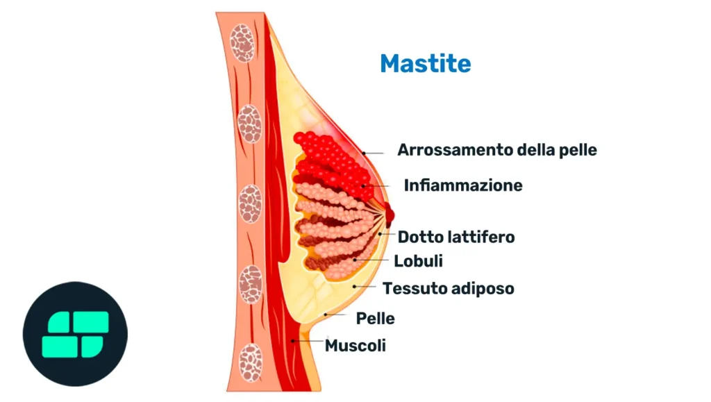 Anatomia della mammella e mastite