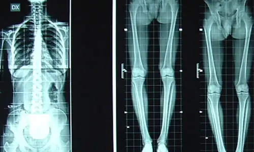 Moc, per ciascun singolo paziente la decisione deve essere personalizzata