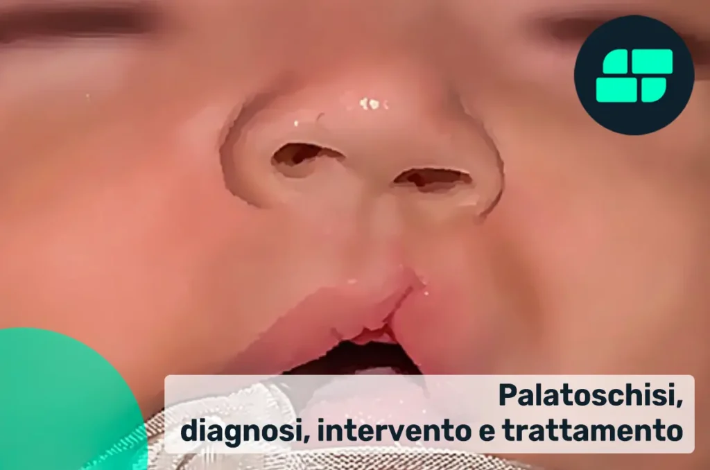 Palatoschisi
