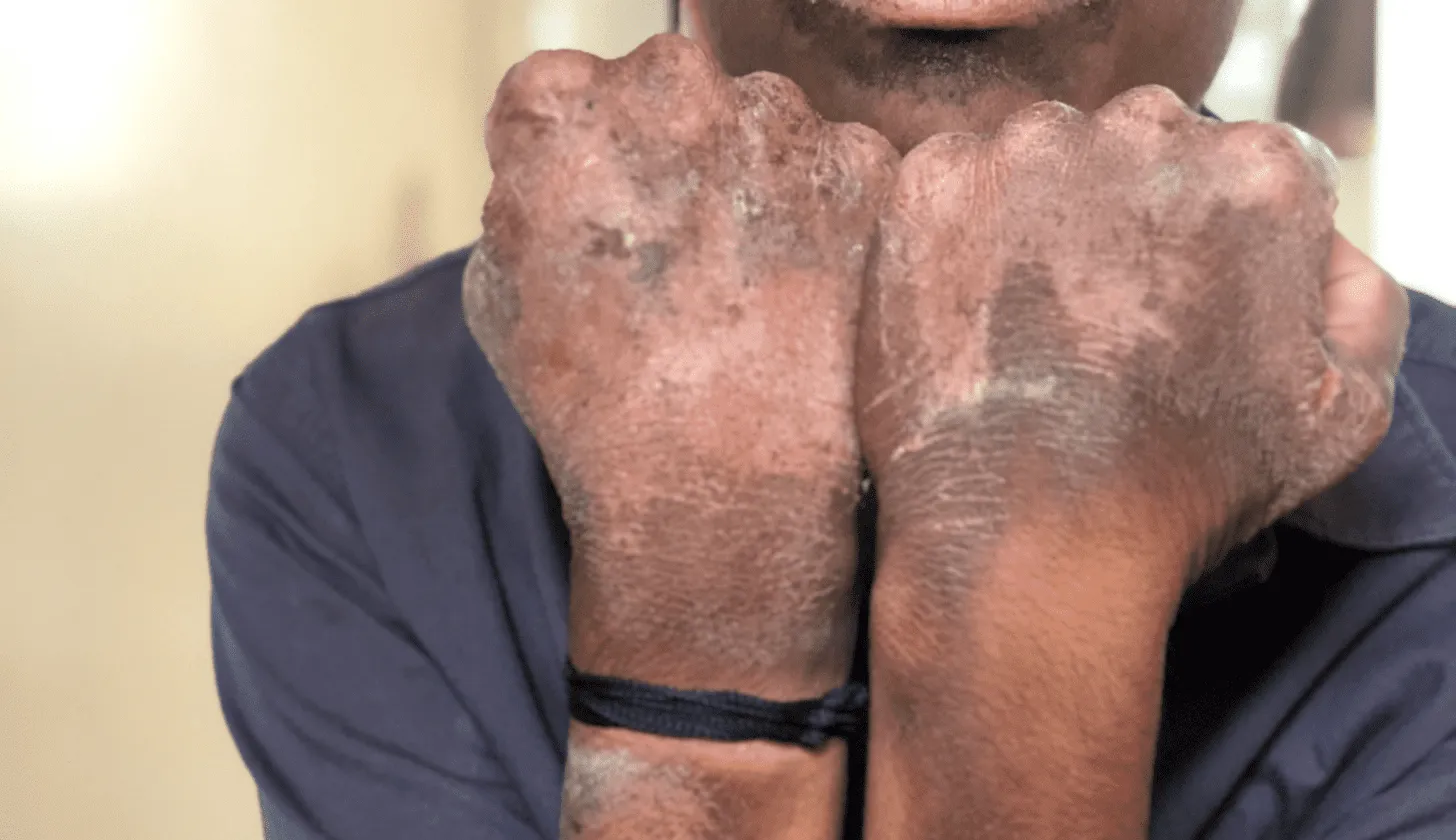 Pellagra, Patologia da Carenza di Niacina