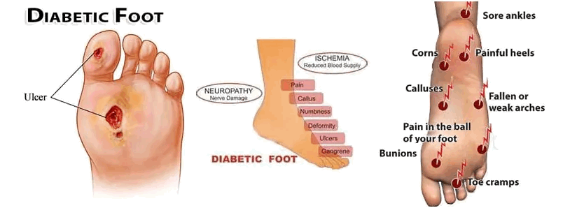 Caratteristiche del piede diabetico