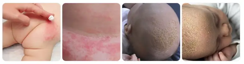 Le principali problematiche cutanee nei neonati