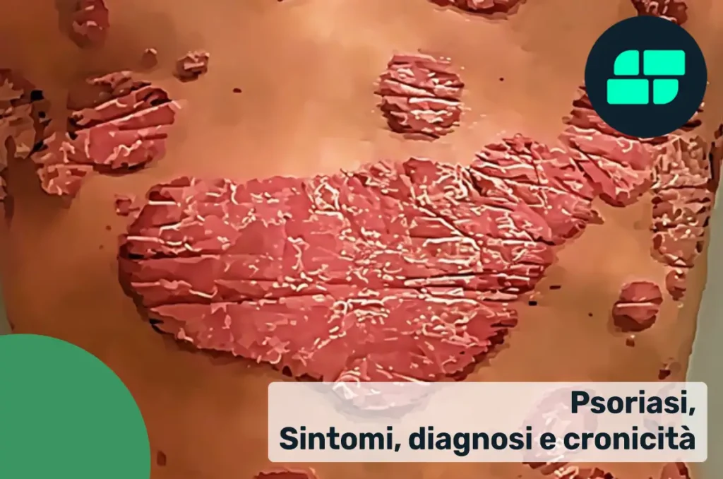Sintomi psoriasi