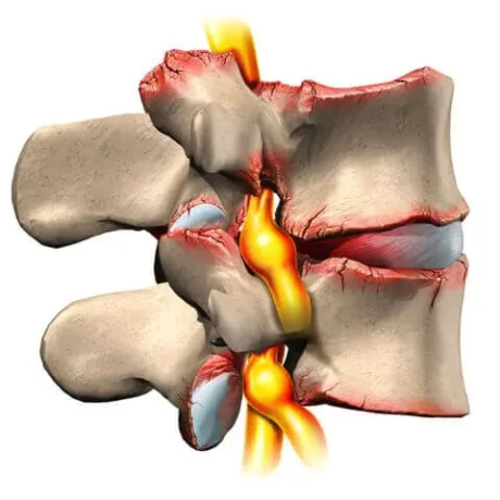 Stenosi vertebrale