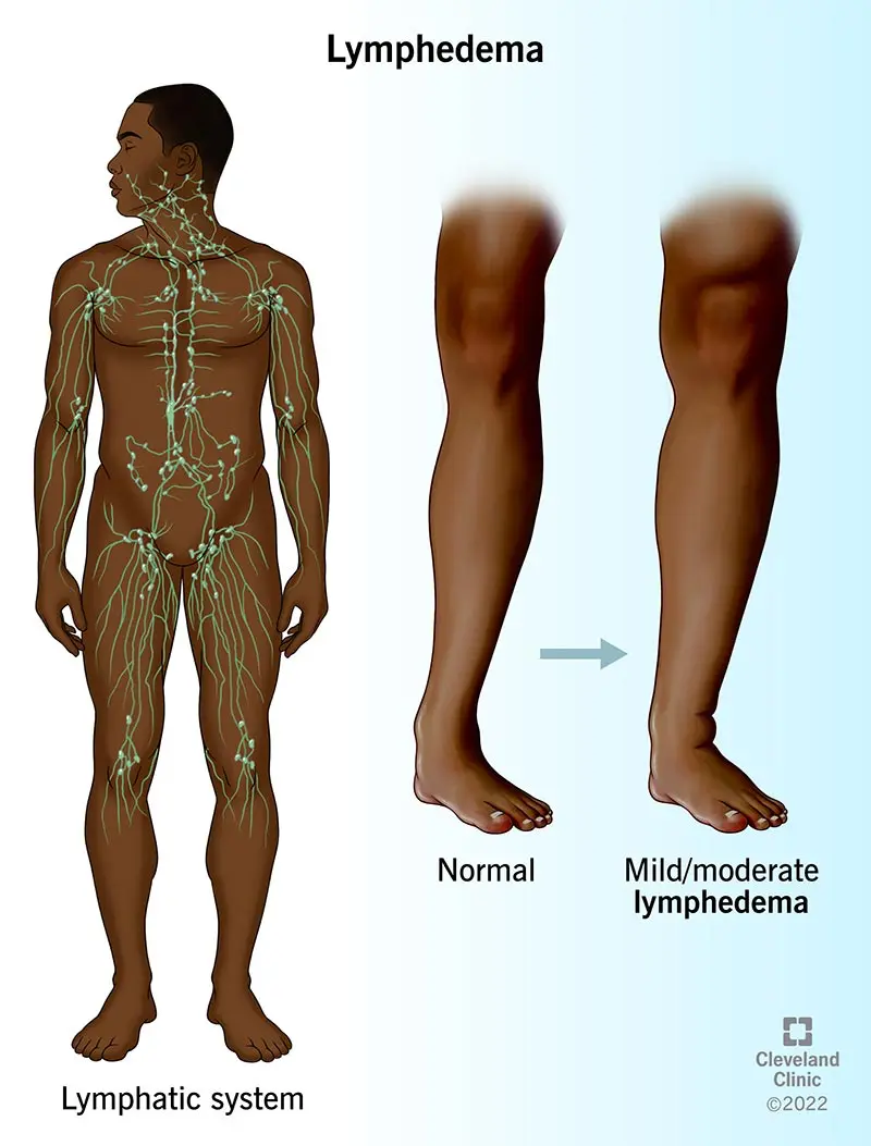 Linfedema