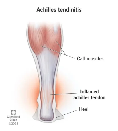 Tendine di Achille © Cleveland Clinic