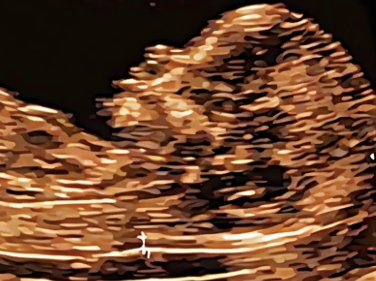 Cos’è la translucenza nucale, quando farla e a cosa serve?