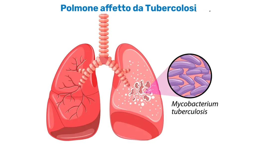 Tubercolosi